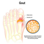 Unraveling the Roots of Gout: Understanding the Causes