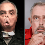 First Successful Face Transplant in Canada Gives New Hope to Patients